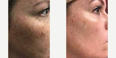 Woman treated with IPL, Lumecca - Lumecca Most powerful and focused IPL in the world! CLEAR BEAUTIFUL SKIN IN 1 WEEK? This patient had amazing results with LUMECCA after just one treatment! (Left: Before. Middle: Same day of treatment. Right: 1 wk after) 
