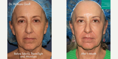 45-54 year old woman treated with Laser Resurfacing, ThermiTight, Liposculpture - Take 10, ThermiTight, and microlipo to rejuvenate skin and sculpt neck and chin