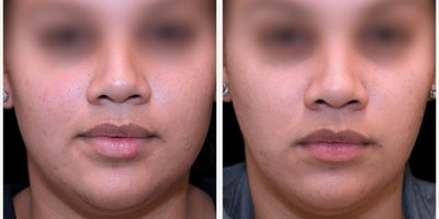25-34 year old woman treated with Botox for TMJ - Check out these amazing results from botox for masseters.