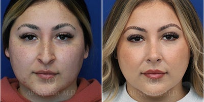 Woman treated with Rhinoplasty - Woman treated with Rhinoplasty