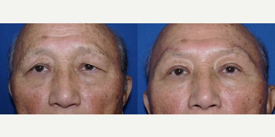55-64 year old man treated with Brow Lift - 55-64 year old man treated with Brow Lift