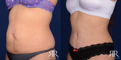 Tummy Tuck - Tummy Tuck