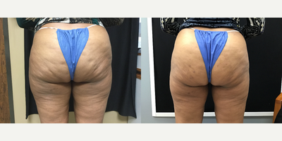 35-44 year old woman treated with Cellfina - Cellfina on the buttock for cellulite