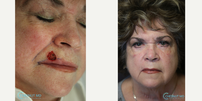 Lip reconstruction after basal cell carcinoma - BCC removed with Mohs surgery and reconstructed
