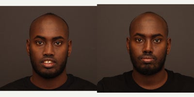 18-24 year old man treated with African American Rhinoplasty - Rhinoplasty with dorsal augmentation and tip projection