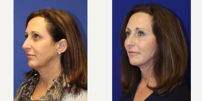 55-64 year old woman treated with Facelift, Neck lift, Upper Blepharoplasty, Fat Transfer and more.. - Facelift, Neck lift, Upper Eyelid Blepharoplasty, Lower Eyelid Skin Pinch, Full Face Laser and Facial Fat Transfer, 3 months post op
She is a 58 year old female not happy with her tired appearance. She works out a lot and has been doing fillers and injectables to improve her appearance, however, she was unable to achieve the rejuvenation she was looking for.
Here she is 3 months post her procedure, performed under local anesthesia and you can see how much more refreshed and rejuvenated she appears. Her eyelids are more open, her neck and jawline are well contoured and her skin is resfreshed and well volumized.