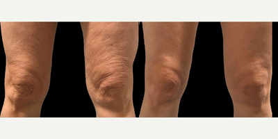 Woman treated with Microneedling RF - Woman treated with Microneedling RF