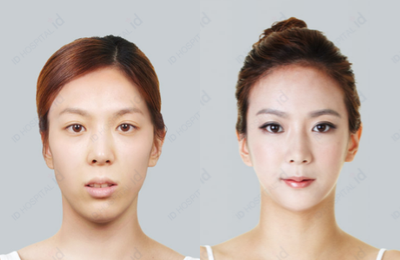 25-34 year old woman treated with Facelift - No-tie double jaw surgery, Square Jaw V line surgery, Barbie Line rhinoplasty.
