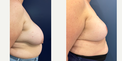 45-54 year old woman treated with Breast Reconstruction Revision, Breast Implants, Breast Reconstruction with Fat Transfer, Nipp - This patient originally underwent bilateral mastectomy and reconstruction with tissue expanders using breast reduction technique, as well as immediate nipple reconstruction.This was then followed by second stage breast reconstruction which included exchange to breast implants, and fat grafting.The scars will continue to fade over time.