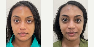 3544-year-old woman treated with Dysport. - Neurotoxin on Masseters.