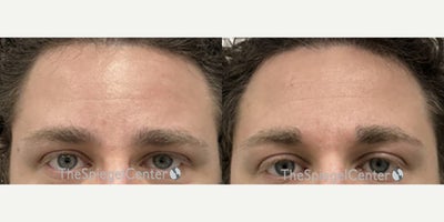 25-34 year old nonbinary person treated with Forehead Reduction - 25-34 year old nonbinary person treated with Forehead Reduction