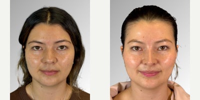 25-34 year old woman treated with Facial - Our patient underwent ultrasonic rhinoplasty and buccal fat removal. She presented with a small nose, thick skin, a dorsal hump, a bulbous tip, nasal asymmetry, and lack of structural support. Through surgery, we achieved better projection, refined and defined the nasal tip, and corrected asymmetries for a more balanced result. Buccal fat removal was the perfect complement, slimming the midface and creating a more sculpted, divine facial contour.
