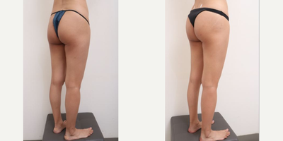Laser Liposuction, Liposuction, Nonsurgical Butt Lift - 33 Years old female patientChief Complain: Hip dips, hip hollows, rectangle shape Treatment Plan: full abdomen liposuction /buttocks, hip dip, butt fat transfer injectionOutcome:- abdomen liposuction pure fat : 1300cc front/ 400cc back side- hip & butt curves enhanced- balanced upper & lower body shape