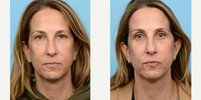 45-54 year old woman treated with Eyelid Surgery, Double Eyelid Surgery, CO2 Laser - This 53-year-old patient complained of aging skin, under eye bags, dark circles, with hooded saggy loose upper eyelid skin. Dr. Wise performed both an upper and lower blepharoplasty, along with full face CO2 laser. Two months post-op her results show a more youthful, rested appearance.