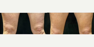 55-64 year old woman treated with BodyTite, Microneedling RF, Morpheus8 - Patient treated with series of Morpheus8 Body and bodytite.