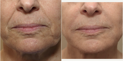 65-74 year old woman treated with RHA Collection Fillers - 71 year old female 6 weeks following hyaluronic acid injectable filler to the nasolabial folds and marionette lines.