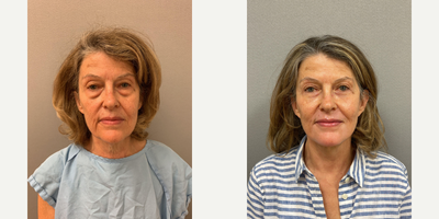 65 year old woman treated with NaturalLift, Eyelid Surgery - 65 year old, NaturalLift, upper and lower eyelid blepharoplasty, Erbium laser mouth, fat grafting lower eyelids