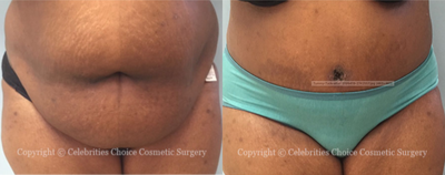 45-54 year old woman treated with Tummy Tuck - This patient had an extended Abdominoplasty to remove excess skin and fat, as well as muscle tightening.