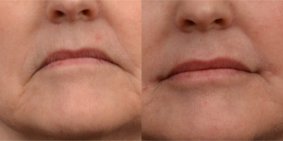 55-64 year old woman treated with Lip Lift - corner of lip lift for downturn to outer portion of lip