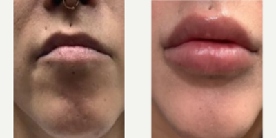 25-34 year old woman treated with Lip Fillers, Vollure, Juvederm - Patient wanted really voluptuouslips