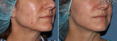 35-44 year old woman treated with Inmode Fractora Forma - Fractora Forma is for individuals who are looking for a non-invasive and natural looking approach to improve skin tone, laxity, and irregular texture. Patients who have tried Fractora Forma report smoother skin, with visible lift, improved definition, and decrease in wrinkles. Fractora Forma is safe for all skin types and can even be performed on tanned skin.How RF Skin Tightening Works- Fractora Forma can treat sagging skin on the entire face or the lack of definition in certain areas like the crows feet, upper eye lids, naso-labial folds (laugh lines), jowls, and neck. Treatment of the body may include arms (bat wings), abdomen, thighs, knees, and other areas that can benefit from tissue contraction. For best results, it is recommended that weekly sessions are performed in a six week period.. For pronounced laxity, your provider may recommend 8 treatments over an 8 week period. The best candidates for this procedure are at their optimal weight. Any weight changes post treatment (weight loss or weight gain) can alter results.