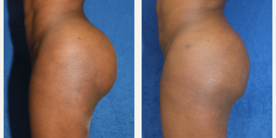 25-34 year old woman treated with Silicone Injection Removal - Meet our resilient patient, a 34-year-old black female who stands at 5'6 and weighs 140 pounds. Unfortunately, she had raw silicone injected into her buttocks in Houston, TX, which resulted in a series of health complications and concerns.To address the issue, she underwent VASER lipo with the exceptional Dr. J. Timothy Katzen to partially remove the silicone from her buttocks. The procedure significantly improved her condition and relieved her issues.The patient is now feeling much better after getting the silicone removed and is grateful for Dr. Katzen's expertise and support throughout the process. We applaud her bravery and perseverance in seeking treatment and wish her continued success and well-being.