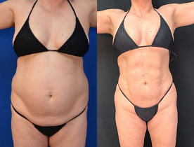 Woman treated with Liposuction, Renuvion - Woman treated with Liposuction, Renuvion