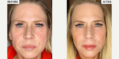 Woman treated with Dermal Fillers - Woman treated with Dermal Fillers