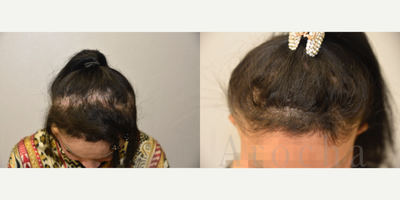 45-54 year old woman treated with Scalp Micropigmentation - This woman came to us with scarring on the top of her head. She wanted to camouflage the scar to give that area the appearance of density. Dr. Arocha and team performed a state-of-the-art scalp trico-pigmentation procedure. The after results were taken one day after her first session. As you can see, the results instantly managed to cover the scar.