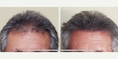 55-64 year old man treated with Scalp Micropigmentation and Hair Transplant - Left shows hair transplant results. (he was bald before)  He was happy, but wanted MORE.
Right shows SMP on top of the hair transplant result.