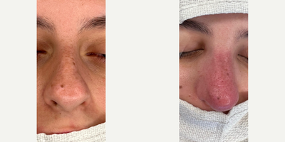 18-24 year old woman treated with Rhinoplasty, Septoplasty, Sinus Surgery - Very swollen immediate post op result showing that the nose contour is much more feminine and smoother. The nasal tip will be significantly narrower and refined.