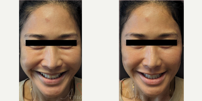 45-54 year old woman treated with Juvederm, Volbella, Voluma, Restylane, Liquid Facelift - Liquid Facelift with fillers for mid-face, cheeks and temples volume restoration (Voluma, BellaFill, Juvederm, Restylane, Sculptra)