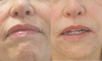 Perlane injections for chin assymmetry  - 	Perlane injections for chin assymmetry. Before and after pictures of Perlane injections for chin.
