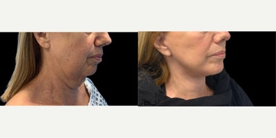 65-74 year old woman treated with Deep Plane Facelift, Facelift, Lower Facelift, SMAS Facelift, Neck Lift - Procedures:Exteneded deep plane faceliftDeep necklift