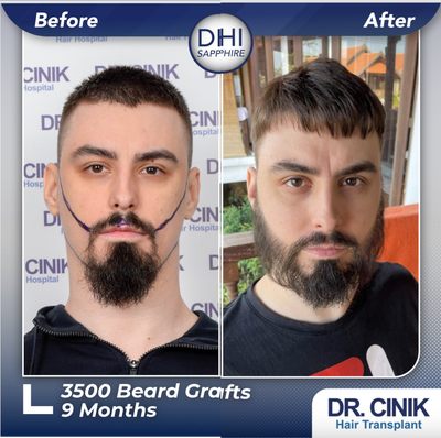 25-34 year old man treated with Beard Transplant - 3500 grafts