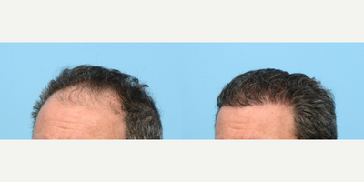 45-54 year old man treated with FUE Hair Transplant, Hair Transplant, Hair Loss Treatment, PRP for Hair Loss, Kybella - Dr. Wise performed an FUE hair transplant on this patient to rebuild his hairline, add overall density, and fill in his crown. During the procedure he used 3,550 grafts and one treatment of PRP.
