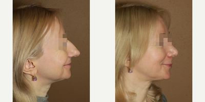 Woman treated with Rhinoplasty - Woman treated with Rhinoplasty