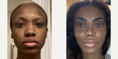 Woman treated with Cheek Augmentation - Woman treated with Cheek Augmentation