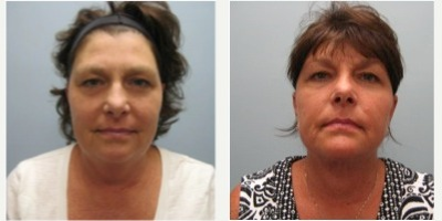 45-54 year old woman treated with Neck Lift & Chin Liposuction - 53 year old woman treated with Neck Lift & Chin Liposuction