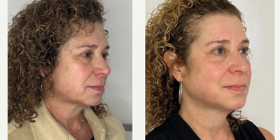 55-64 year old woman treated with Microneedling RF, CO2 Laser - 60 year old after 2 sessions of RF Microneedling + 2 CO2 micropeel