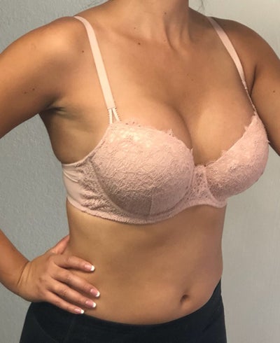 24 Years Old . 36A to 36D I Love my New Boobies - Review - RealSelf
