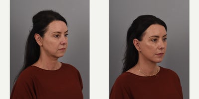 45-54 year old woman treated with Brow Lift, Buccal Fat Removal, Deep Plane Facelift, Facial Fat Transfer, Neck Lift - 48 year old who underwent deep plane facelift, deep neck lift, temporal brow lift, fat transfer, buccal fat reduction and chin implant 3 months ago.