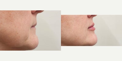 45-54 year old woman treated with Lip Fillers, Revanesse, Restylane - Needed Lip Renaissance with natural results