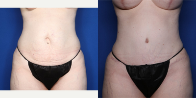 35-44 year old woman treated with Mommy Makeover, Breast Lift with Implants, Natrelle Breast Implants, Tummy Tuck - 42 y/o female shown 6 months after a bilateral breast augmentation and lift with round Natrelle silicone implants (365 cc on R and 415 cc on L) and a tummy tuck with liposuction.