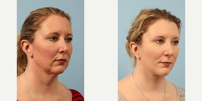 35-44 year old woman treated with Cheek Lift - A 43 year old woman before and after Cheek and Necklift w/Anterior Platysmaplasty by Andrew T. Lyos M.D., FACS. She was most bothered by her lower neck and jowling.