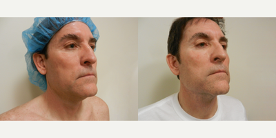 Man treated with Neck Lift - Neck Lift & Fat Transfer (to eyes)
