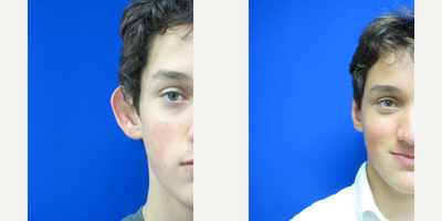 Man treated with Ear Surgery - Dr. Schaffer performed Otoplasty (ear surgery) also known as ear pinning.