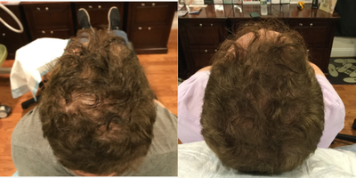 55-64 year old man treated with Hair Loss Treatment - Hair restoration with PRP and laser treatment.