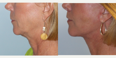 55-64 year old woman treated with Facelift - Facelift performed by Dr. Bryson Richards