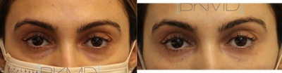Under eye/ tear trough filler for dark circles - Dr. Kotlus performed a conservative under eye filler to reduce the dark circles without looking like something was done.
